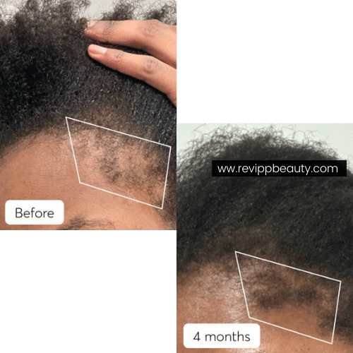 Revipp Beauty Hair Products, 4 months hair growth journey 